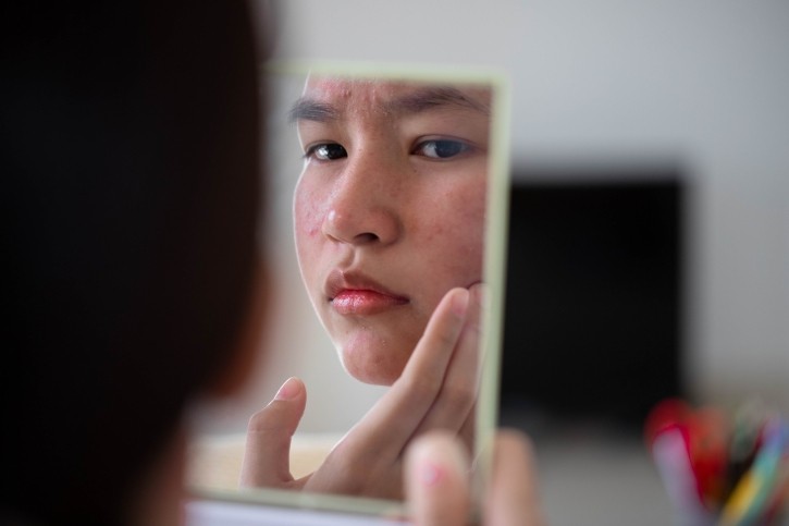 "We are pushing ourselves to create acne-safe products that check all the boxes," said Fry. © Arisara_Tongdonnoi Getty Images